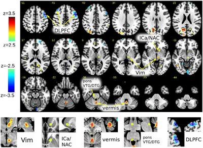 A Neuroanatomy of Positive Affect Display – Subcortical Fiber Pathways Relevant for Initiation and Modulation of Smiling and Laughing